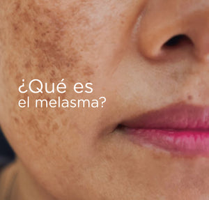 ¿Qué es el melasma?.